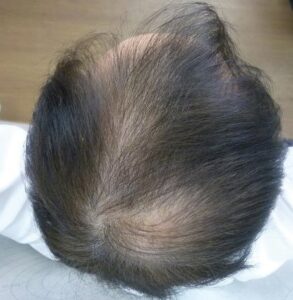 育毛・薄毛ハゲお悩み：AGAを治すにはどうすればいいですか﻿？(公開質問状に回答する)
